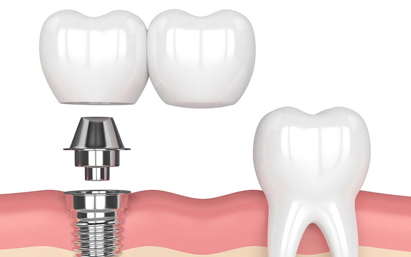 dental-implants-in-dapto