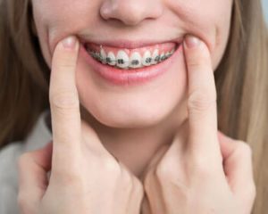 how much is invisalign braces